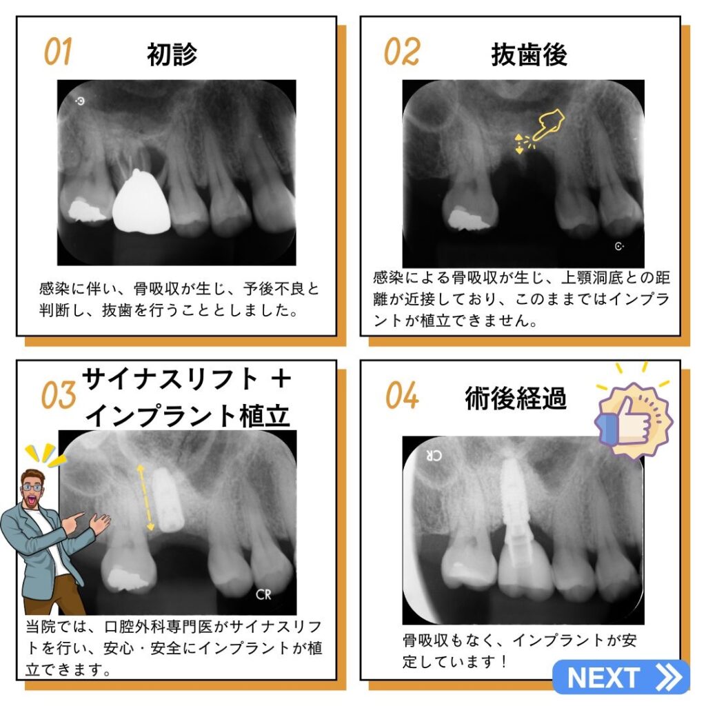 安城市篠目町フォーエバーデンタルクリニックで行ったサイナスリフト・骨造成インプラント手術の術前・術後比較のデンタルx線・レントゲン写真